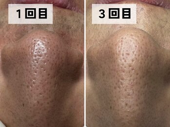 エアル(earu.)/BA|毛穴ケア|ピーリング|高円寺