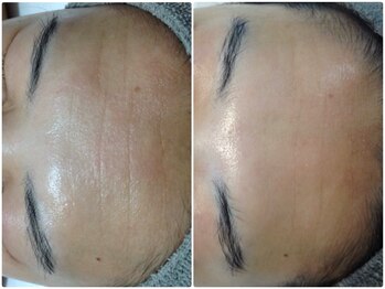 ルノン(LUNON)/ビフォーアフター集