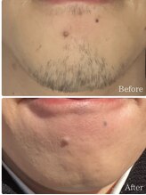 ルタンリッシュオム(Lutan Riche hom)/痛みの少ない脱毛