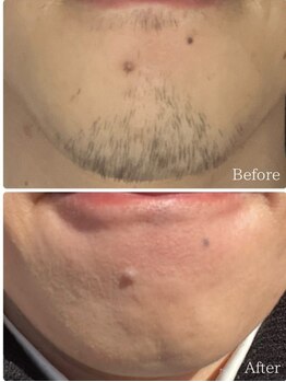 ルタンリッシュオム(Lutan Riche hom)/痛みの少ない脱毛