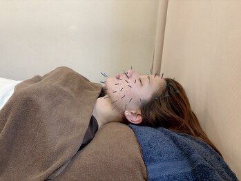 こじま 富雄団地接骨院/ヒト幹細胞美容鍼