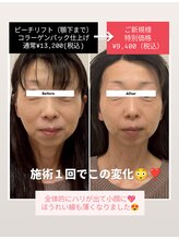 クレール 小山店(CLAIR)/【小顔&シワ改善】ピーチリフト