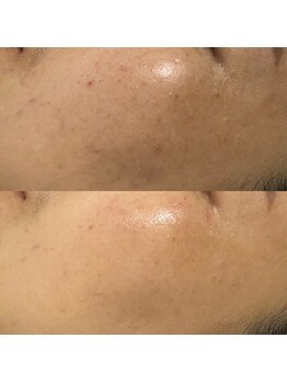 フューチャーズ ミィー(futures mii)/セラピール　症例