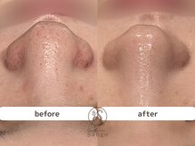 サンゴ(Sango)/毛穴黒ずみ/開き/ざらつき改善