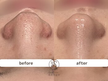 サンゴ(Sango)/毛穴黒ずみ/開き/ざらつき改善