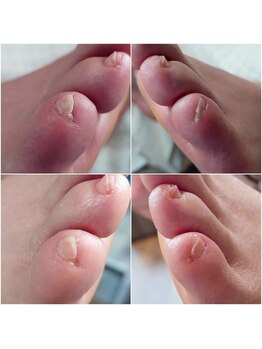 アンティ(Aunty)/副爪(小爪)