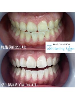 ホワイトニングサロン 熊本店/【ホワイトニング施術例】