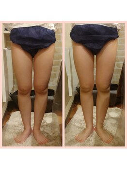 リュストゥール アンド フォンス(Lustr'e&fons)/ハイパーナイフで美脚をめざせ!!