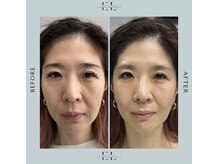 スプレール 水戸店/ExoLif（エクソリフト）