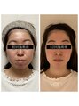 キュープ 静岡店(Qpu)&nbsp;美肌美顔器コースで小顔になるのはもちろん、お肌もキレイに♪
