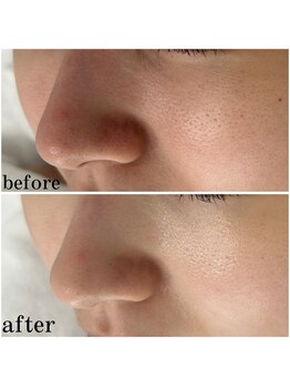 プラセル(Placer)/赤み・黒ずみもお任せください☆