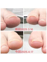 ココネ(cocone)/巻き爪解放ケア