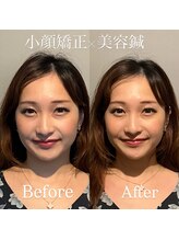美容鍼灸サロン ユールーム(YOUROOM)/【ビフォーアフター】