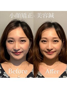 美容鍼灸サロン ユールーム(YOUROOM)/【ビフォーアフター】