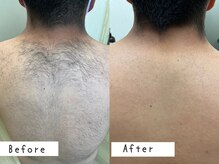 セルフメイド 高崎店(SELFMADE)/男性背中脱毛12回