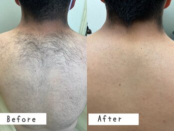 セルフメイド 高崎店(SELFMADE)/男性背中脱毛12回