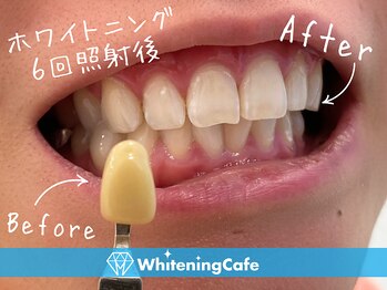 ホワイトニングカフェ 志木店/ホワイトニングビフォーアフター