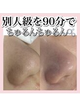 アルムダアクア 天王寺店(Aleumda AQUA)/毛穴エクストラクションプロ大阪