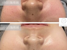 ラヴィオーラ 川崎(La Viora)/ダイヤモンドハーブピーリング