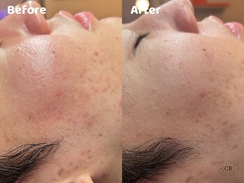 クリスタルビューティ 渋谷/NEW【韓国ミルクスキンピール】