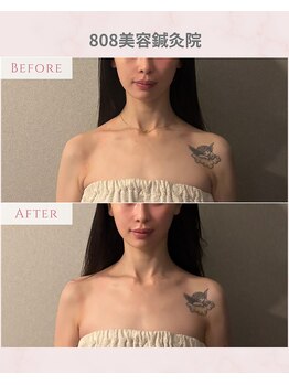 ハチハチ(808)/美容鍼/ソフトダーマW導入