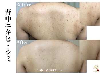 ローズフィールド(Rosefield)/RFピール/背中ニキビ/シミ/毛穴