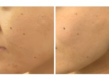 イーオ(io)/デコボコ毛穴が…