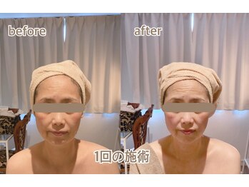 ラ フルール 折尾店/小顔矯正コルギ×炭酸パック