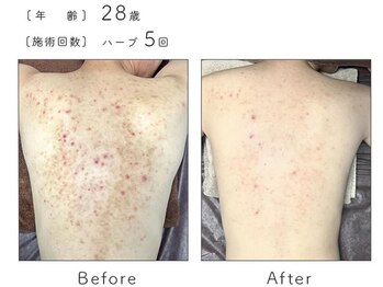 カノン(Kanon.)/リベルハーブピーリング