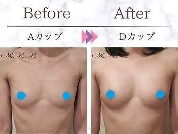 メディカルサロン エム エム エム 銀座プレミアムサロン(M.M.M.)/【バストアップ例】 A→Dカップ