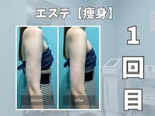 エックス(X)/【痩身】脂肪撃退！！