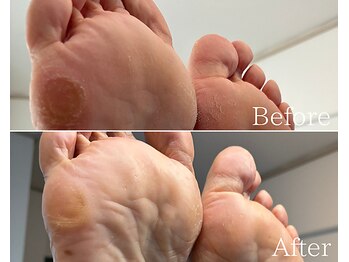 カシェット 広島店(Cachette)/50代女性☆足裏角質ケア90分