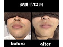 脱毛部門連続受賞業界NO.1VICTORIA導入★頑固な髭や白髪にも◎！