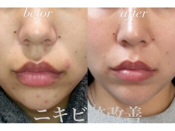 リツイート(ReTweet)/ハーブピーリング・IPL