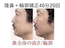 ラプリシュシュ 岡山店(Raplit)/隆鼻＋輪郭矯正40分20回