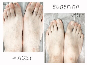 エイシー(ACEY)/ビフォーアフター☆足