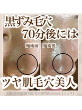 ミュウ(miuex)/毛穴エクストラクション