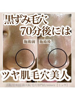 ミュウ(miuex)/毛穴エクストラクション