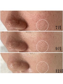 プラセル(Placer)/開きは徐々に浅くなっていく。