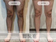 メンズプラス(MEN’S PLUS)/脚脱毛