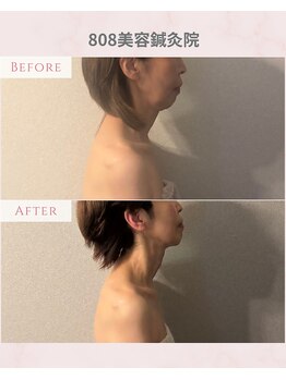 ハチハチ(808)/美容鍼/ソフトダーマ