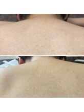 リフビューティ(LIF Beauty)/脱毛のBefore/After