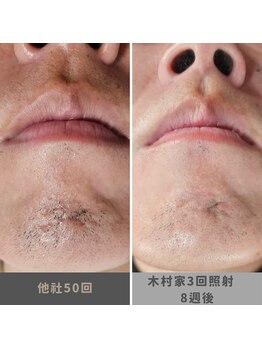 キムラケ 和光別邸(木村家 KIMURAKE)/メンズ脱毛ヒゲビフォーアフター