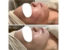 ルル(RuRu)/REVI陶肌トリートメント