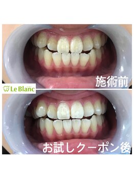ルブラン 奈良店(Le Blanc)/口臭気になる方!