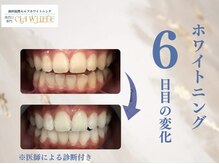 シアホワイト(CIA WHITE)/劇的ビフォーアフター