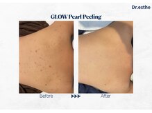 オーシャンブルー 福岡店(OCEAN BLUE フェイシャル&ボディ)/背中ニキビケア