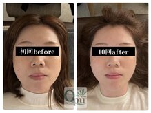 キュープ 富士店(Qpu)の雰囲気(1対1で丁寧に小顔矯正をいたします。お子様連れご友人とご来店◎)