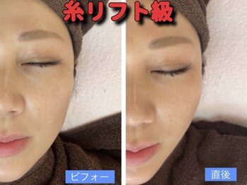 アイリー(IRIE)/インモード　ワンセラ