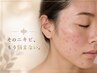 【赤み/炎症ニキビ】うんざり敏感ニキビに終止符 何しても変わらなかった方へ